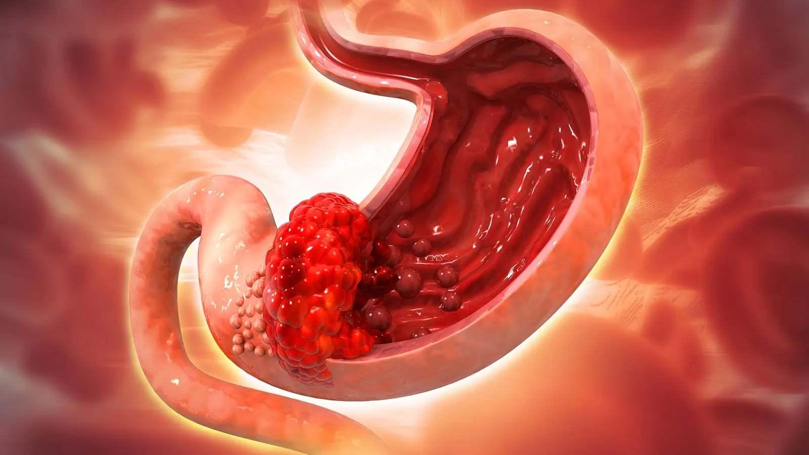 Miten Helicobacter pylori muuttaa mahalaukun soluja esiasteeksi