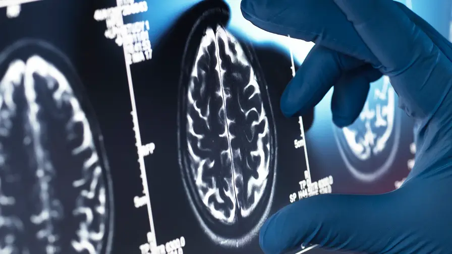 Perifeerinen immuniteetti ja Alzheimerin aivovauriot