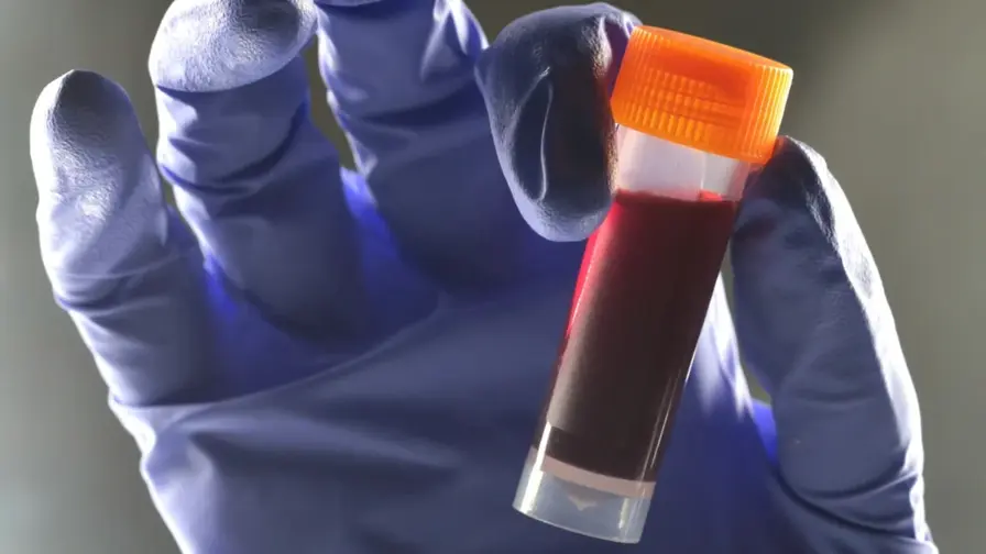 Veriryhmä B liittyy korkeampaan tyypin 2 diabeteksen riskiin